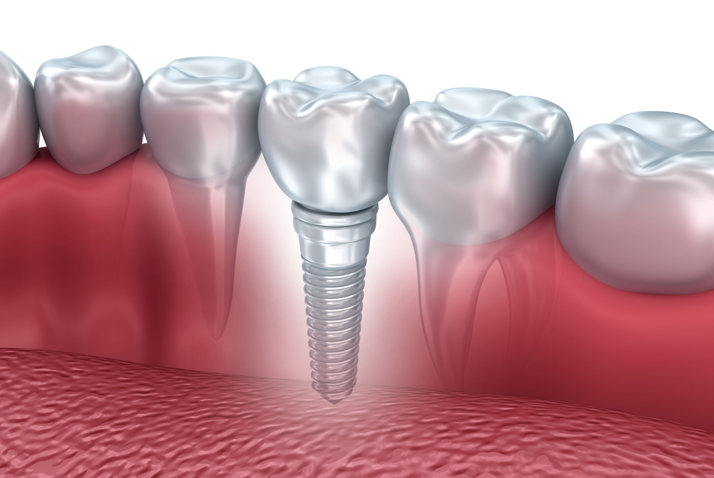 50149095 - tooth human implant, 3d illustration